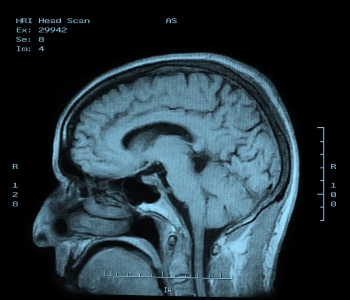 MRI image of the brain.